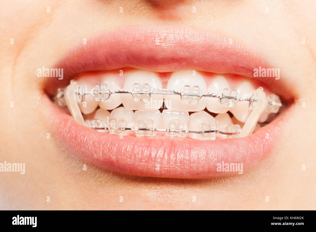Nahaufnahme der Zähne mit Zahnspangen und Gummizüge volle Öffnung Stockfoto