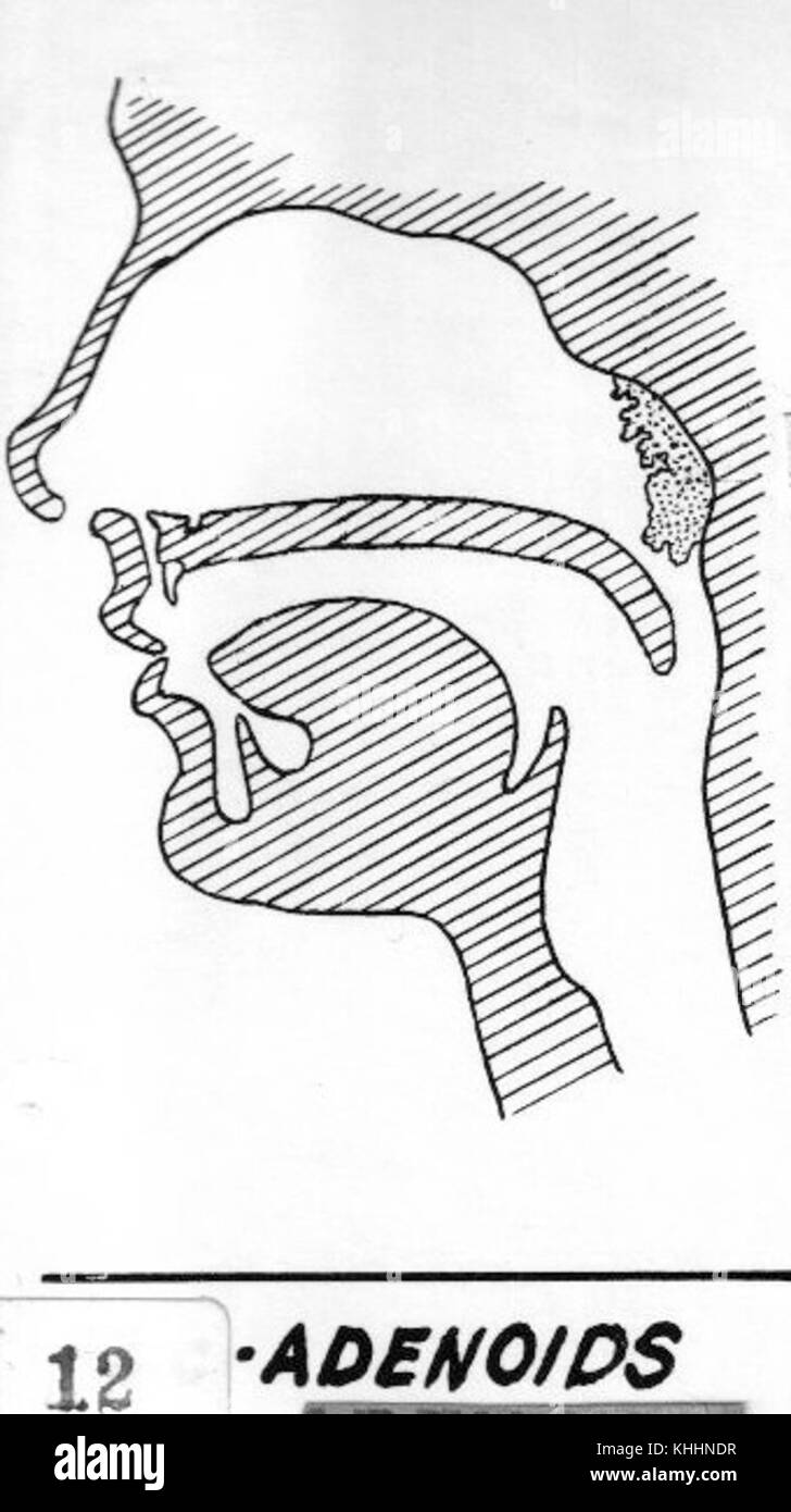 Adenoids (PSF) Stockfoto