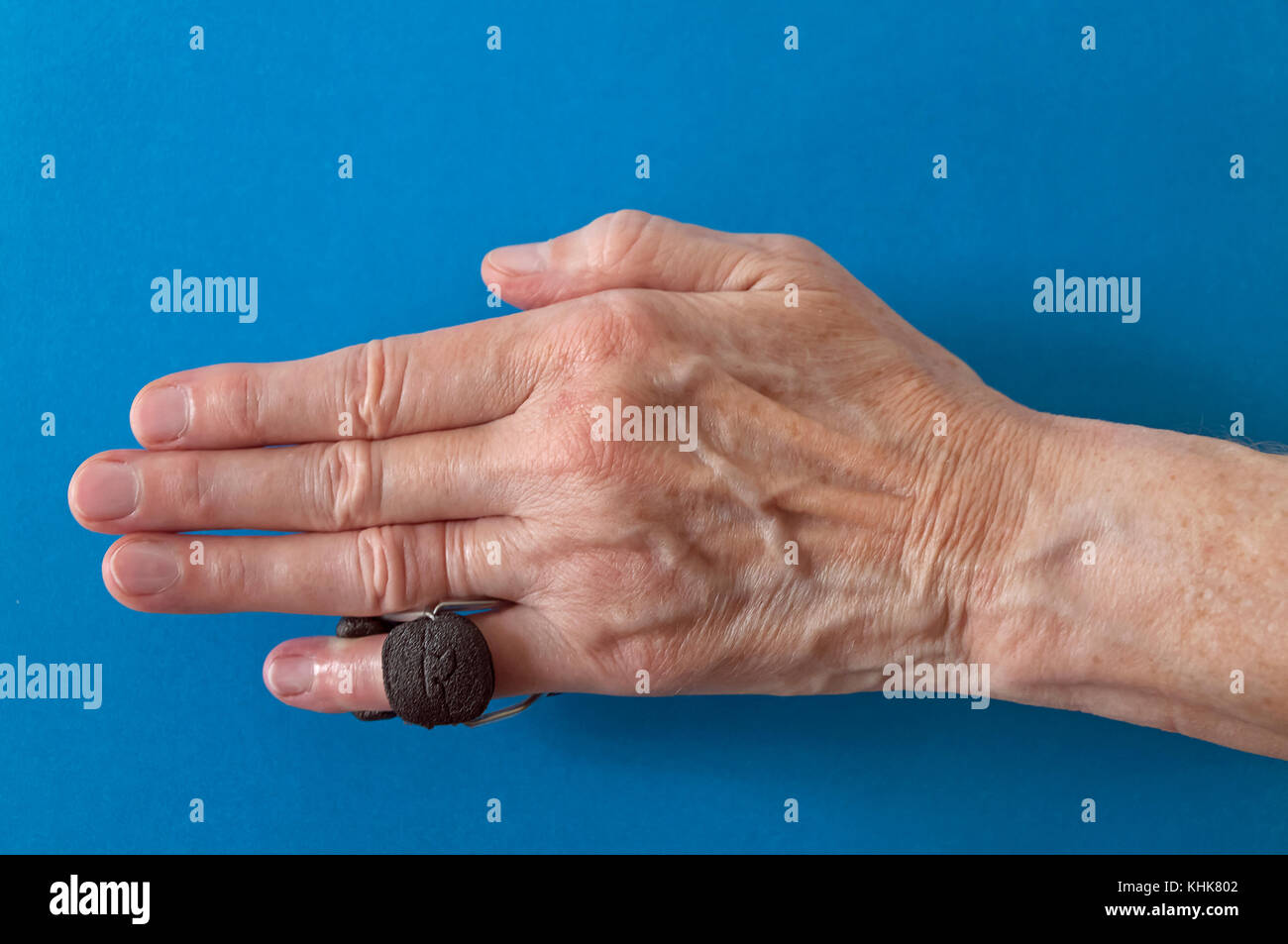 Finger Schiene auf ein wenig 'Pinkie' Finger nach der Dupuytren Kontraktur korrektive Chirurgie Finger zu begradigen und Narbengewebe entfernen. Stockfoto