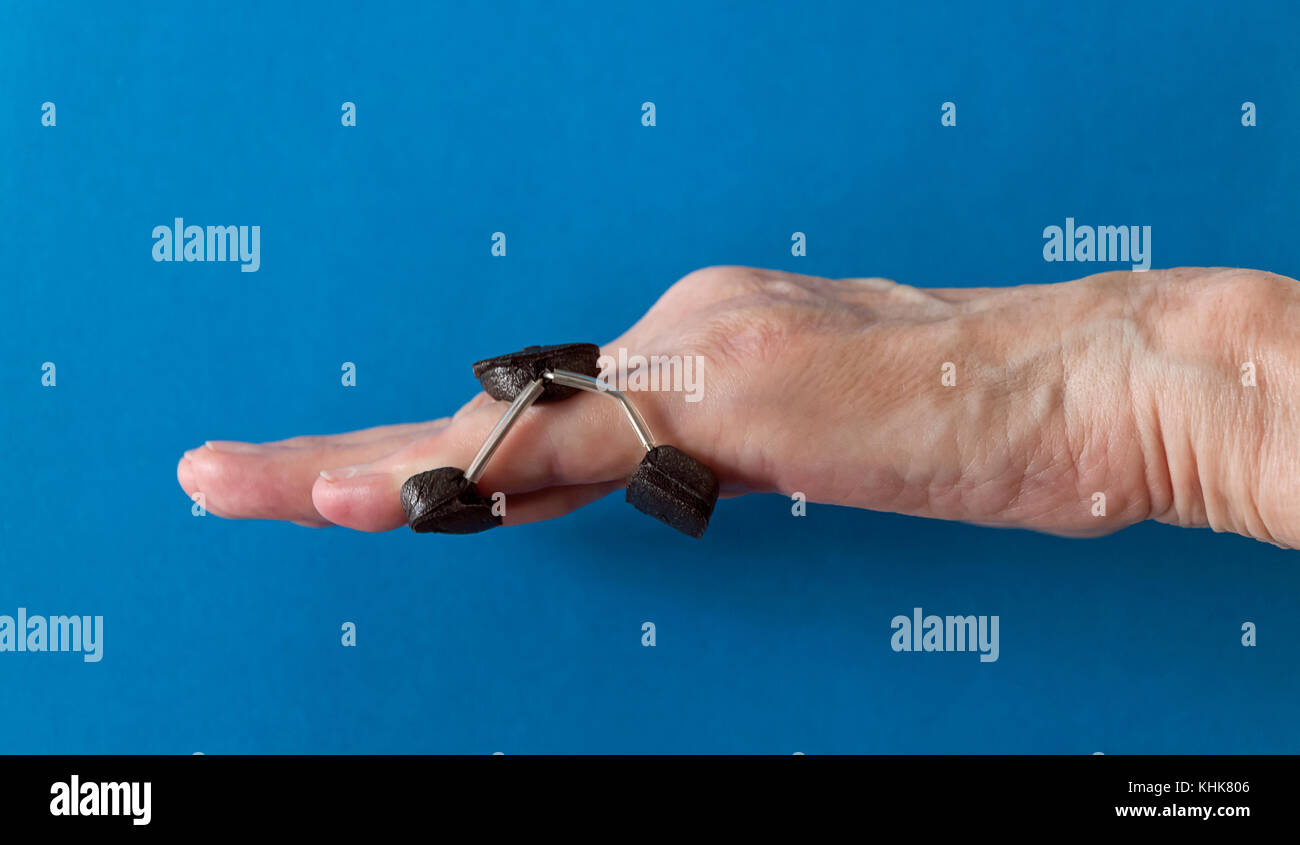 Finger Schiene auf ein wenig 'Pinkie' Finger nach der Dupuytren Kontraktur korrektive Chirurgie Finger zu begradigen und Narbengewebe entfernen. Stockfoto