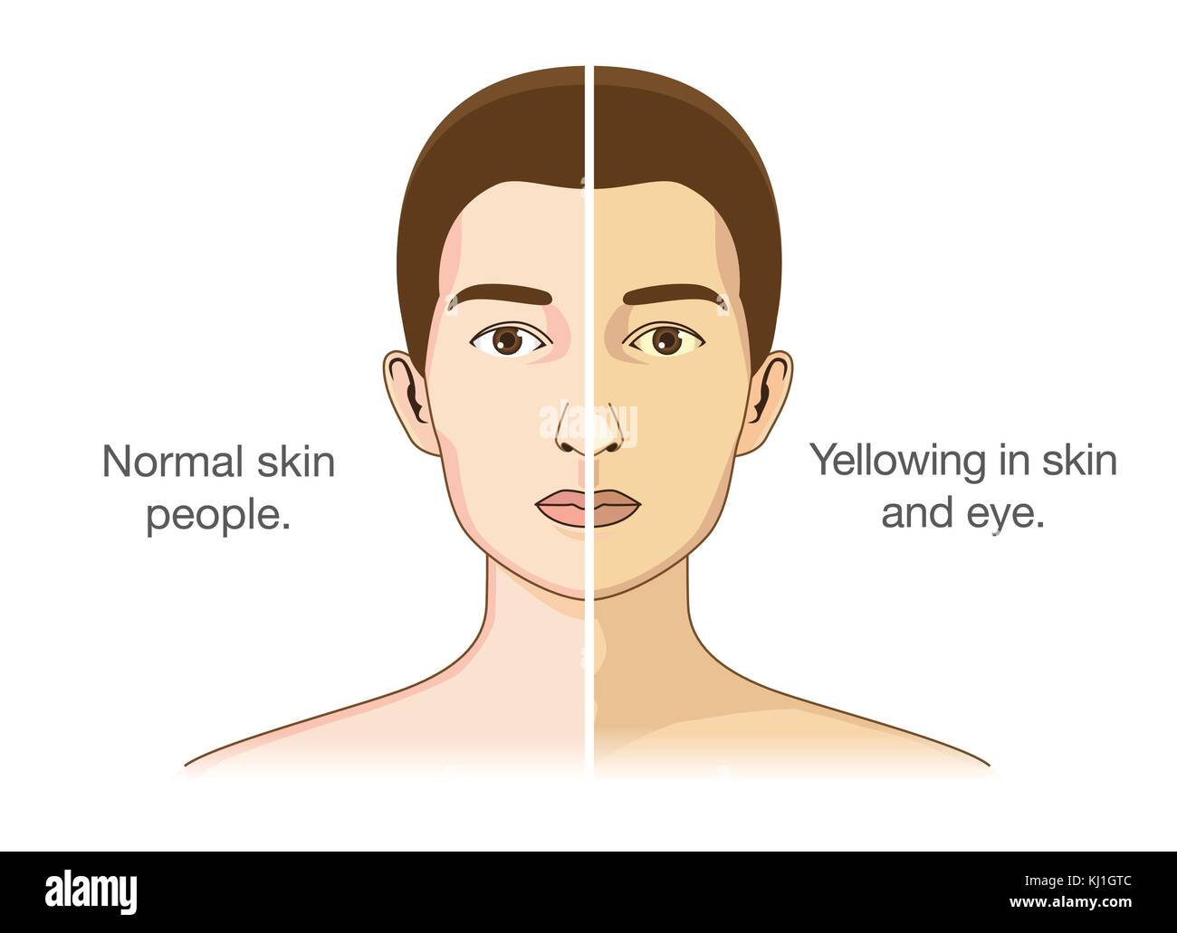 Normale Menschen und Gelbfärbung der Augen und Haut. Stock Vektor