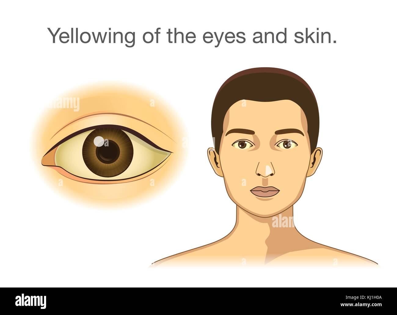 Gelbfärbung der Augen und Haut. Stock Vektor