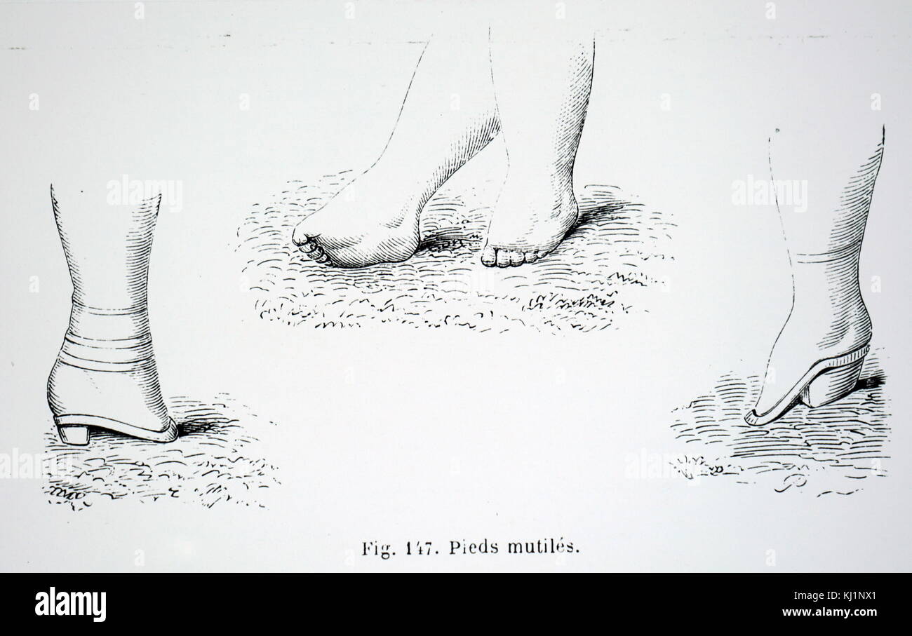 Gravur Darstellung beschädigt Füße zu Fuß in China verursacht. Vom 19. Jahrhundert Stockfoto
