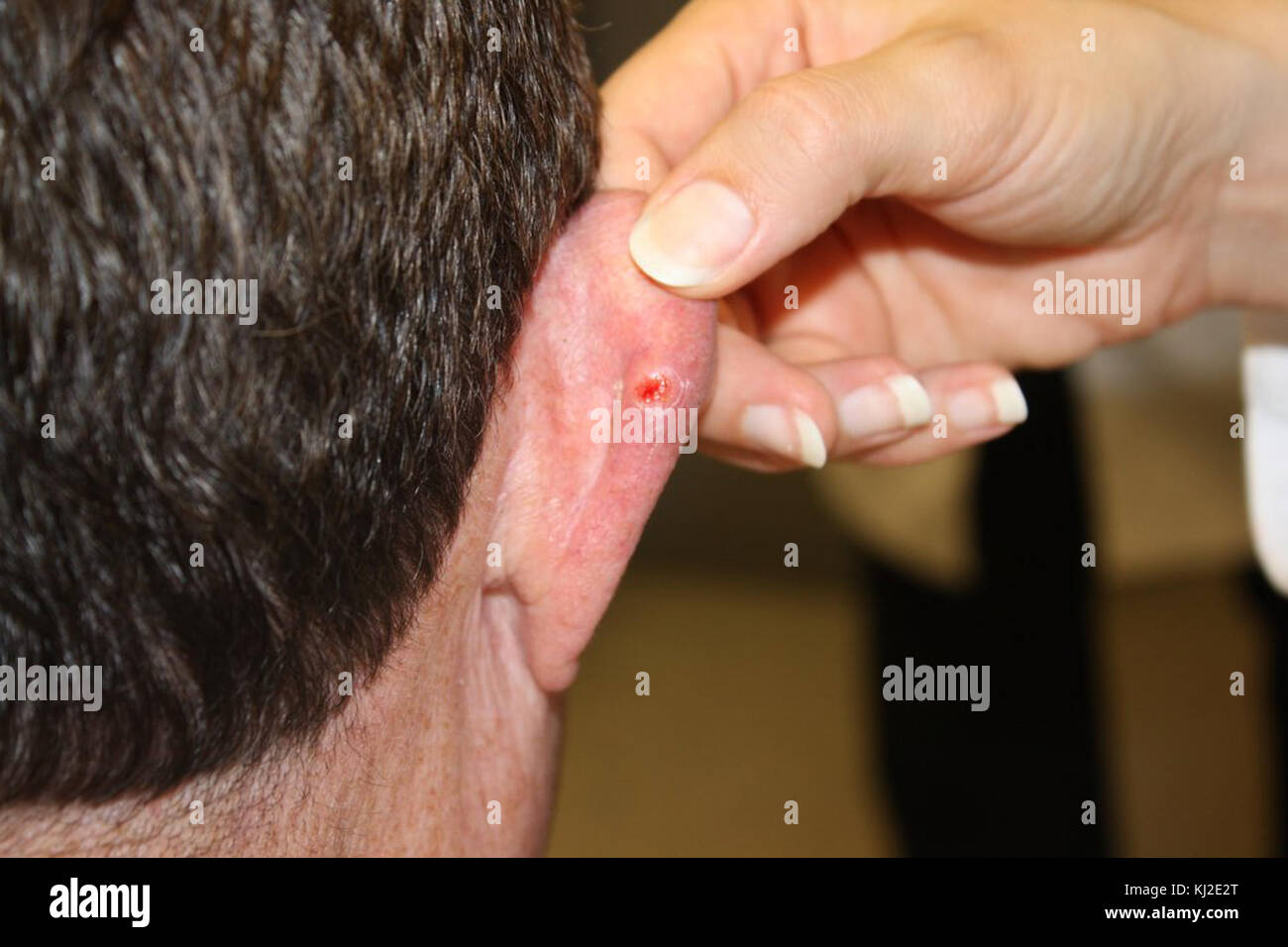 Basaliom (1) Stockfoto