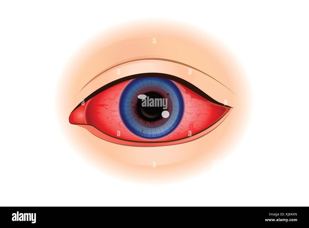 Uveitis Symptome oder Auge Entzündung. Stock Vektor