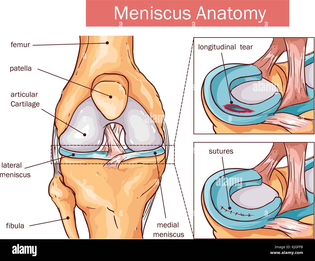 Vector Illustration eines Meniskus reißen und Chirurgie Stock Vektor