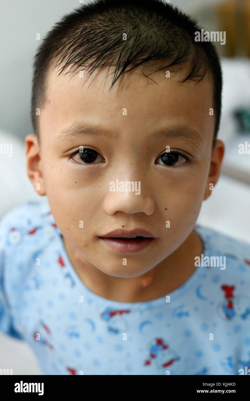 Tam Duc Heart Hospital. Kind Leiden der Herzkrankheit. Ho Chi Minh City. Vietnam. Stockfoto