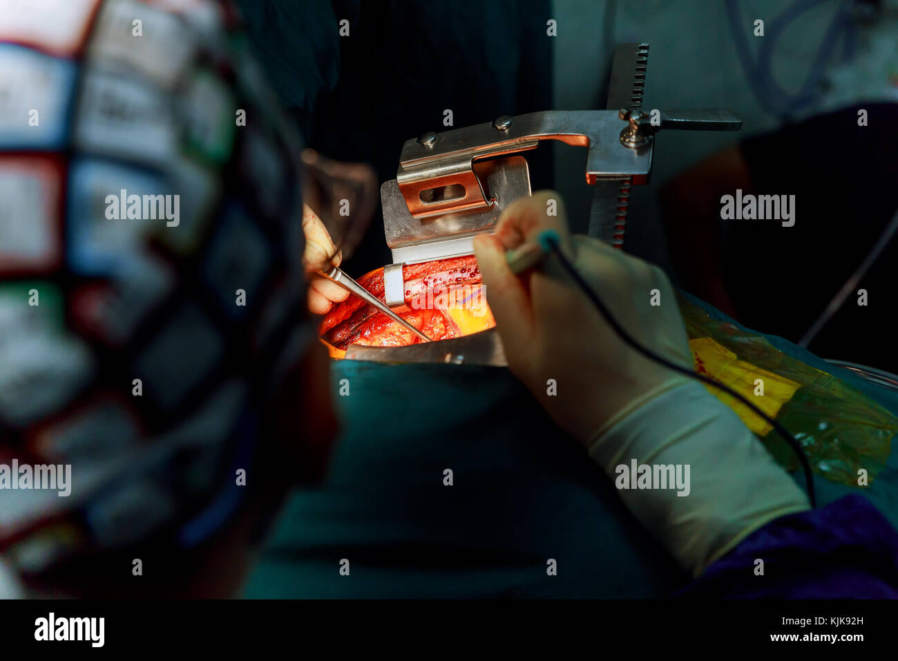 Chirurgen hilft, sich selbst in die Wunde mit chirurgischen Instrument während der Operation am offenen Herzen Stockfoto