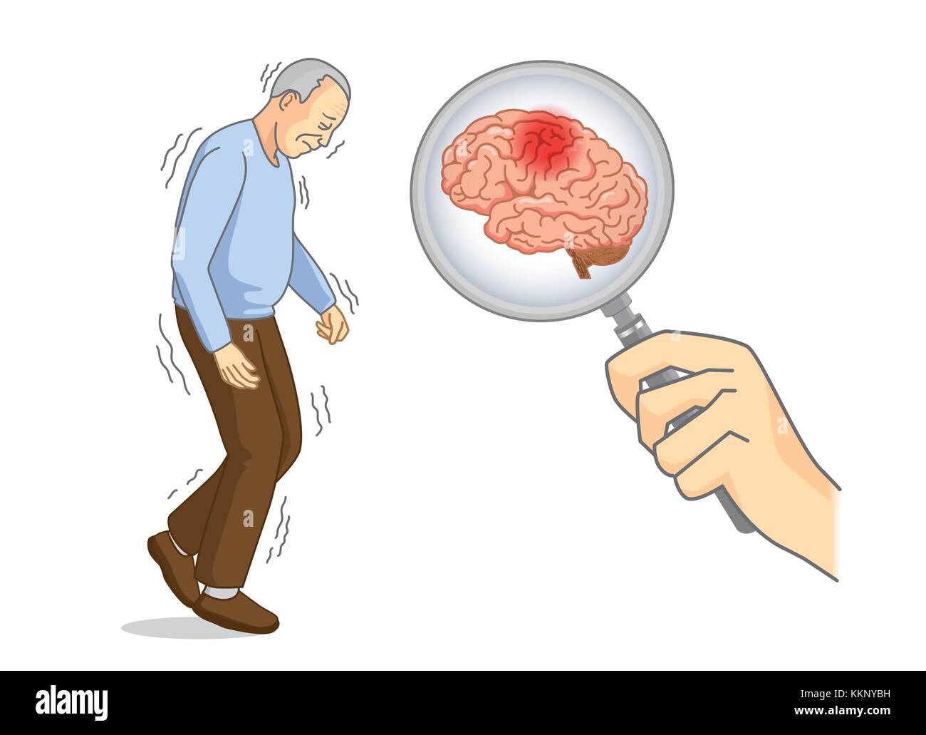 Suche Gehirn der Parkinson Krankheit Patienten mit Lupe. Stock Vektor