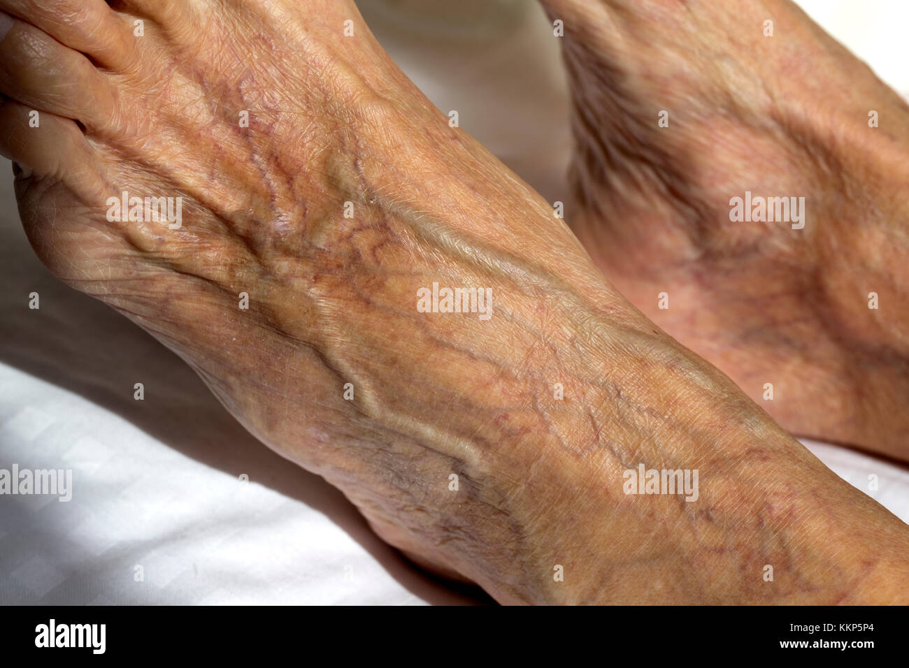 Geschwollene Krampfadern und Besenreiser in Fuß der älteren Frau erweiterten UK Stockfoto