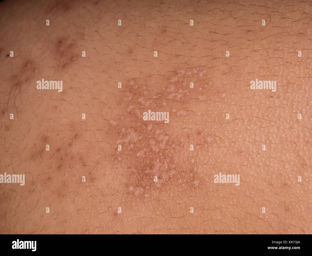 Zoster Stockfotos & Zoster Bilder Alamy