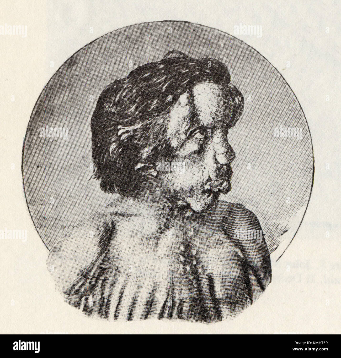 Joseph Merrick, bekannt als der Elephant man, war ein britischer Mann, der Aufmerksamkeit für seine schweren körperlichen Deformitäten erlangte, und seine Geschichte ist ein wichtiger Teil der medizinischen Geschichte. Stockfoto