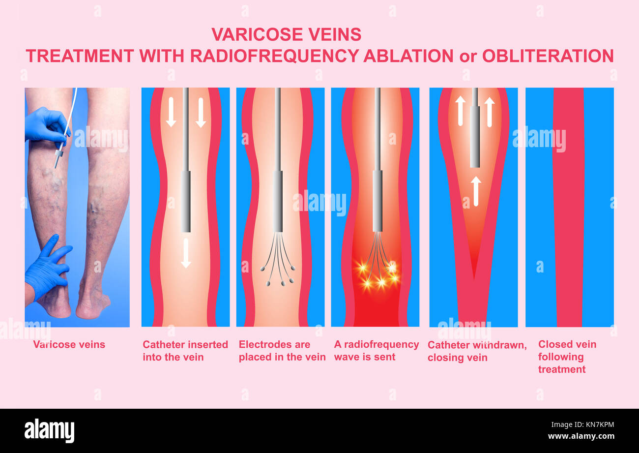 Krampfadern und Behandlung mit radiofrequenzablation Stockfoto