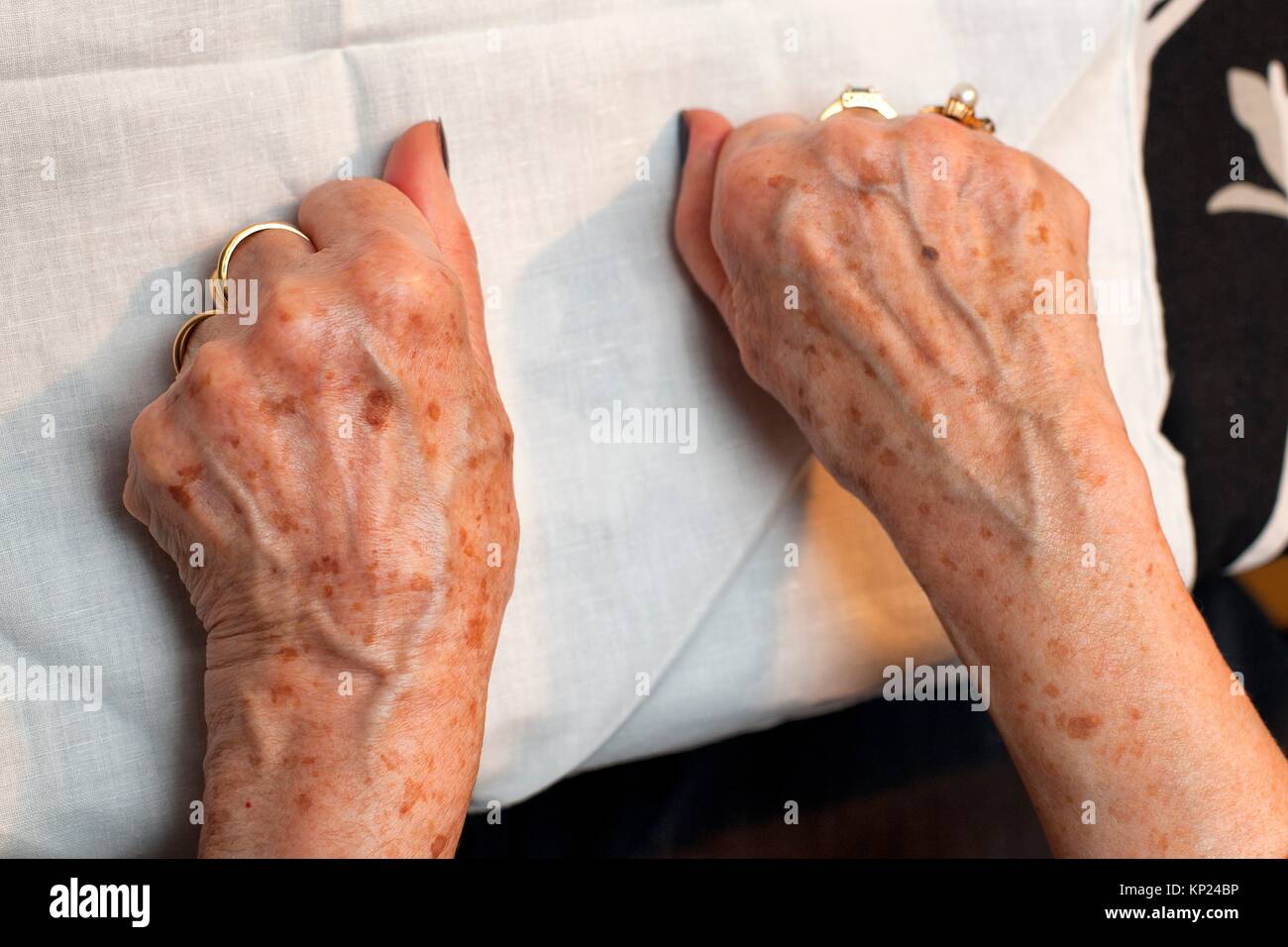 Age Spots Spot Skin Old Fotos Und Bildmaterial In Hoher Auflosung Alamy