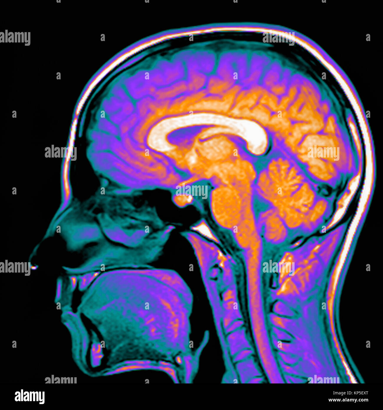 Farbige Magnetresonanztomographie (MRT) Scan eines Sagittalschnitt durch eines Patienten Kopf, eines gesunden menschlichen Gehirns. Stockfoto