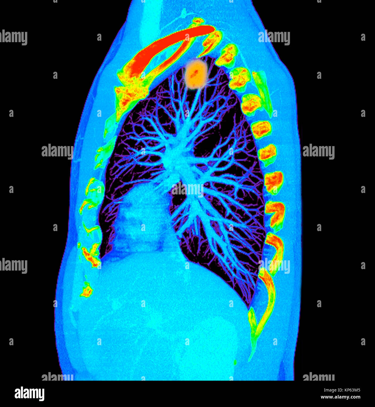 Farbige CTscan der oberen Brust einen Tumor in der Lunge. Stockfoto