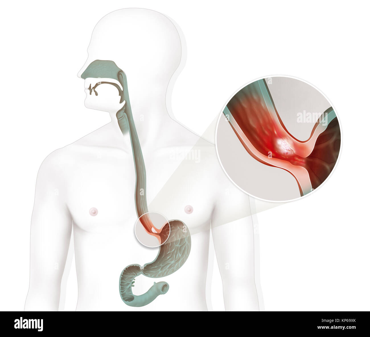 Barrett-ösophagus Stockfoto