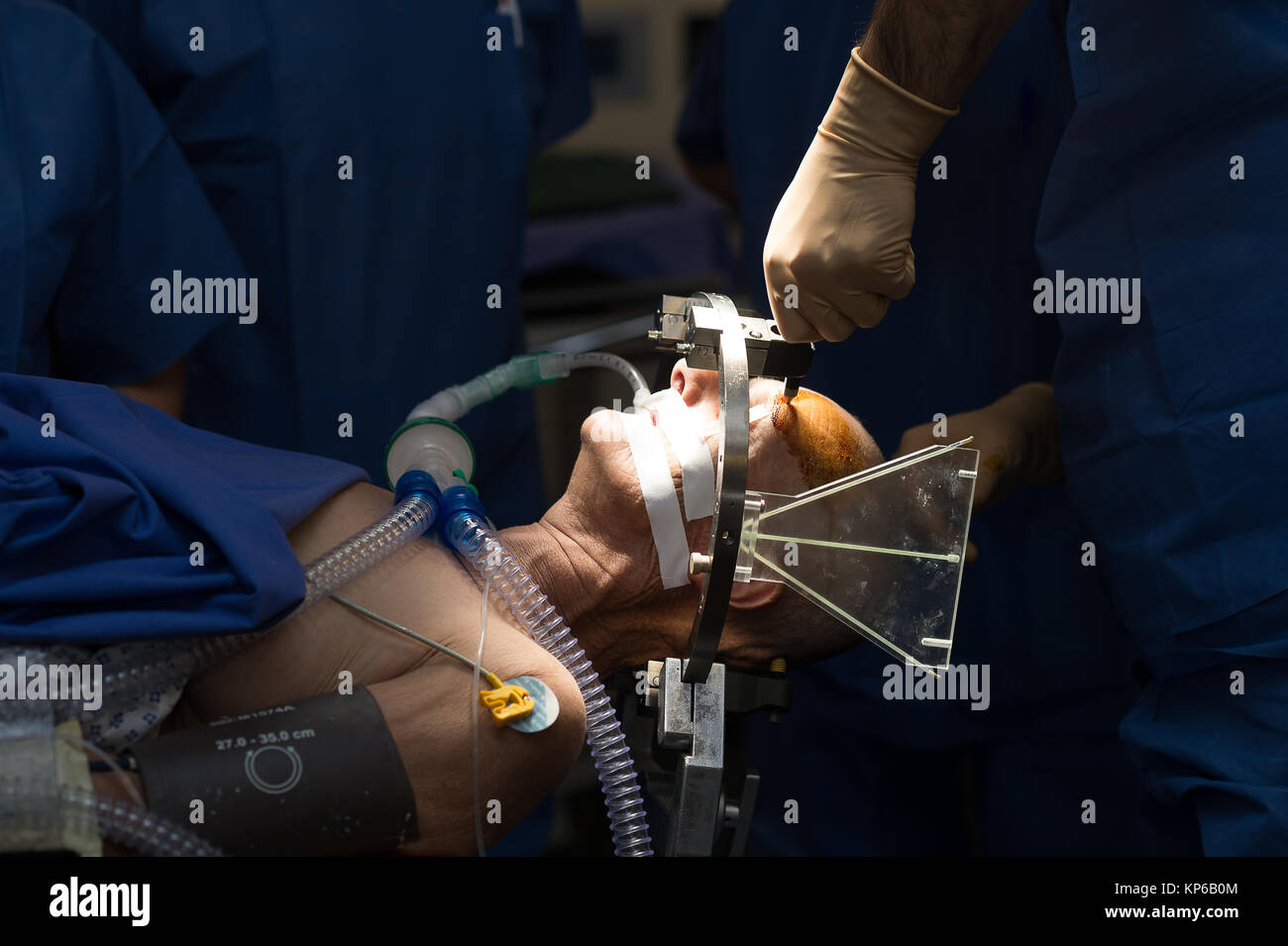 Die tiefe Hirnstimulation Stockfoto