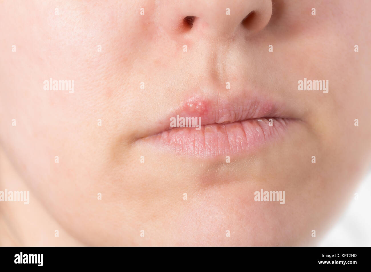 Gesundheit Beschneidung Schutzt Vor Herpes Und Warzenviren Welt