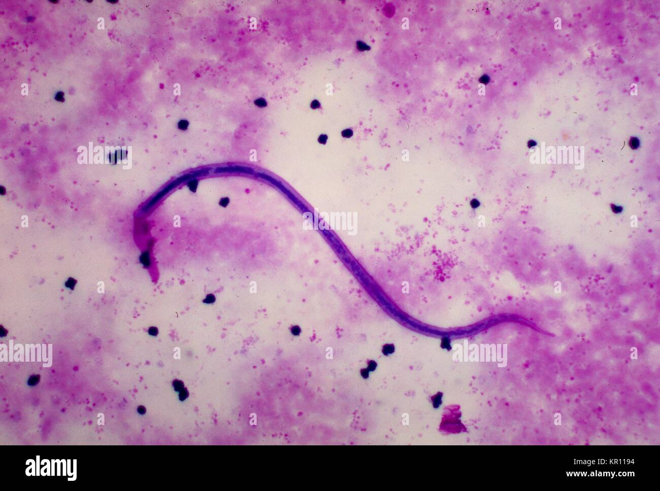 Dies ist eine Aufnahme eines Wuchereria bancrofti microfilaria in einer dicken mit Giemsa Fleck Technik, 1977 Blut verschmiert. W. bancrofti, der häufigsten filarial Parasit im Menschen, ist eines der Erreger, die an lymphatischer Filariose erkrankt sind. Die lymphatische Filariose wirkt sich auf schätzungsweise 120 Millionen Menschen in tropischen Gebieten der Welt. Bild mit freundlicher Genehmigung von CDC/Dr. Mae Melvin. Stockfoto