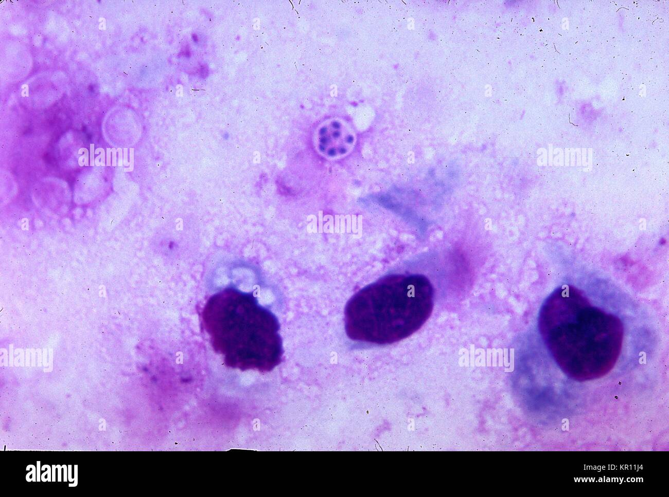 Pneumocystis jirovecii, früher bekannt als Pneumocystis carinii, ist in der Lunge Eindruck bestreichen, mit Giemsa Fleck, 1971. Pneumocystis jirovecii, ist in der Umwelt gefunden, als auch in der Lunge von gesunden Menschen und Tieren, und eine Erkrankung bei immunsupprimierten Personen, und ist wohl die wichtigste Ursache der Pneumonie in immunocompromised Host. Bild mit freundlicher Genehmigung von CDC/Dr. Mae Melvin. Stockfoto