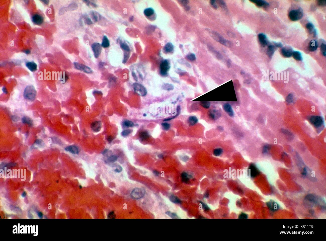 Diese Aufnahme zeigt eine Strongyloides stercoralis Parasiten in der Darmschleimhaut, 1972 eingebettet. S. stercoralis ist ein Parasit, der Fadenwurm infiziert Menschen, Primaten, und Hunde. Der Lebenszyklus ist komplex, wechselnd zwischen frei lebenden und parasitäre Zyklen, und beinhaltet autoinfection und Multiplikation innerhalb des Hosts. Bild mit freundlicher Genehmigung von CDC/Dr. Fred Gilbert. Stockfoto