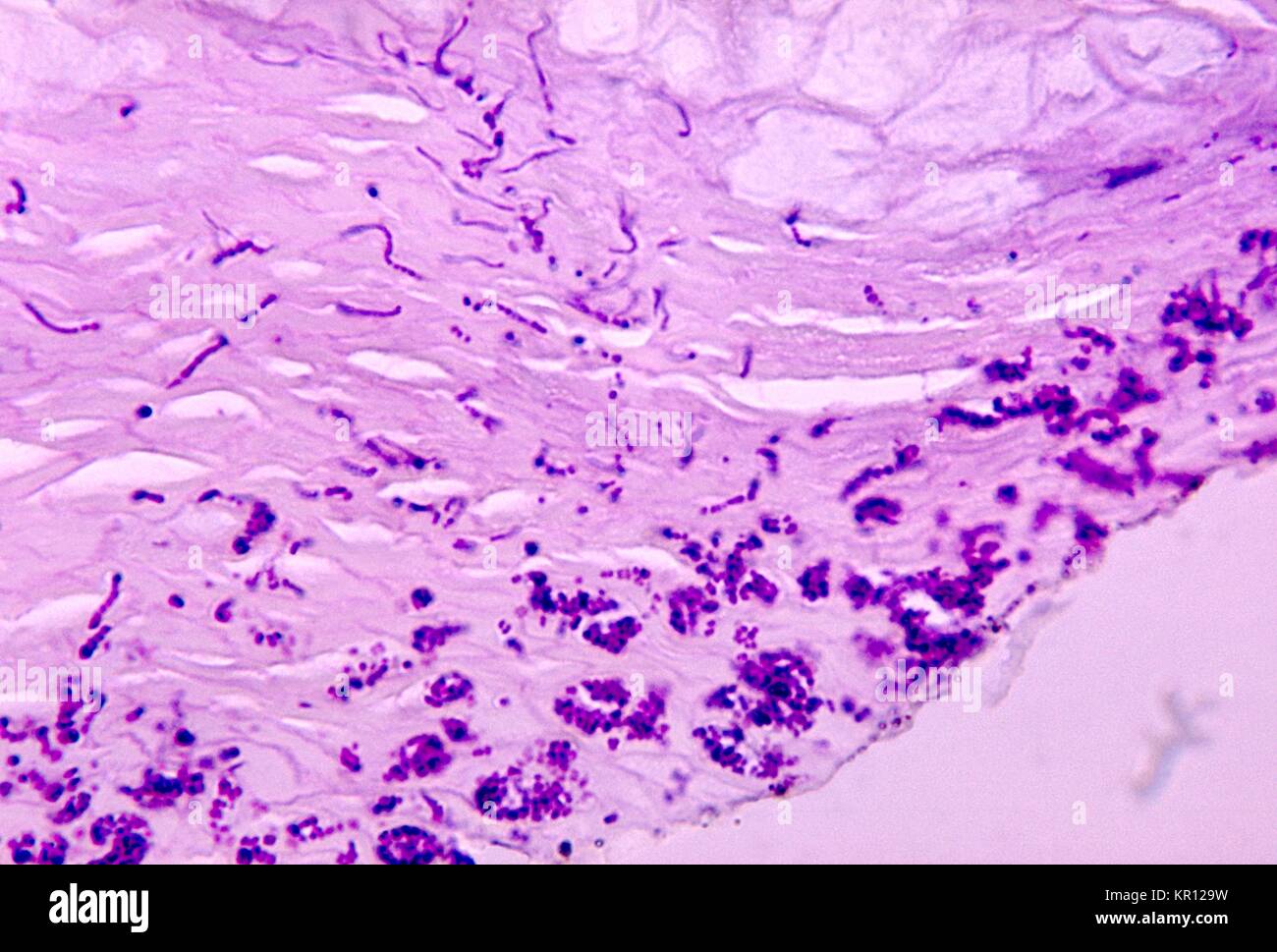 Dieses Gewebe Probe zeigt Anzeichen von Lochfraß durch eine Keratolysis Dermatophilus sp, 1972. Infektion, mit einem PAS Fleck. Narbige keratolysis ist eine Erkrankung der Haut, die sich durch kleine erodiert Bereiche, vor allem die Sohlen der Füße (gelegentlich die Palmen). Die Erscheinungsformen sind aufgrund einer oberflächlichen Haut- bakterielle Infektion. Bild mit freundlicher Genehmigung von CDC/Dr. William Kaplan. Stockfoto
