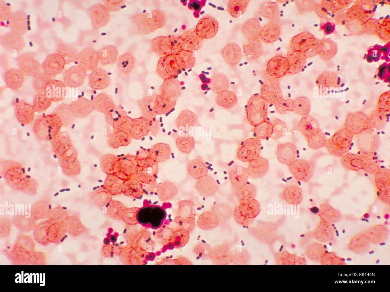 Diese photomicrograph offenbart kokken-förmige Enterococcus sp, 1978. Bakterien von einer Lungenentzündung Patienten berücksichtigt. Enterococcus sp. ist eine gemeinsame, Gram-positive Bakterien, die normalerweise im Darm und weiblichen Genitaltrakt gefunden werden kann. Diese Bakterien können durch fäkal-orale Übertragung verteilt werden, Kontakt mit infizierten Körperflüssigkeiten oder Kontakt mit verschmutzten Oberflächen. Bild mit freundlicher Genehmigung von CDC/Dr. Mike Miller. Stockfoto