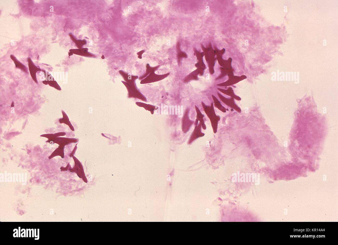 Dies ist eine der photomicrograph protoscolex Haken von Echinococcus vogeli aus eine Zyste in einem Gorilla, 1978. Die Larve der mikroskopischen Bandwurm Echinococcus vogeli ist der Erreger der Alveolären Hydatid Disease (AHD). Die Infektion beim Menschen führt parasitäre Tumore zu bilden, vor allem in der Leber, aber auch in anderen Organen auftreten. Bild mit freundlicher Genehmigung von CDC/Dr. Peter Schantz. Stockfoto
