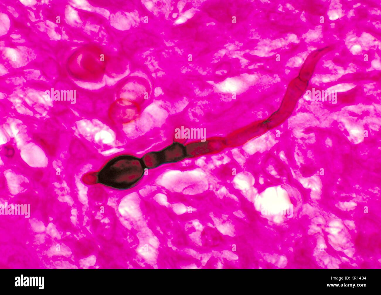 Diese Aufnahme zeigt histopathologic Änderungen, die das Vorhandensein der Pilz Blastomyces dermatitidis Agent, 1978 offenbaren. Blastomykose, verursacht durch Blastomyces dermatitidis, ist eine Grippe - wie Zustand, mit Fieber, Schüttelfrost, Husten, Myalgie, Arthralgie und pleuritic Schmerz in der Brust. Es gibt 1-2 Fällen pro 100 000 Menschen in Gebiete mit endemischen Krankheiten. Bild mit freundlicher Genehmigung von CDC/Dr. Libero Ajello. Stockfoto