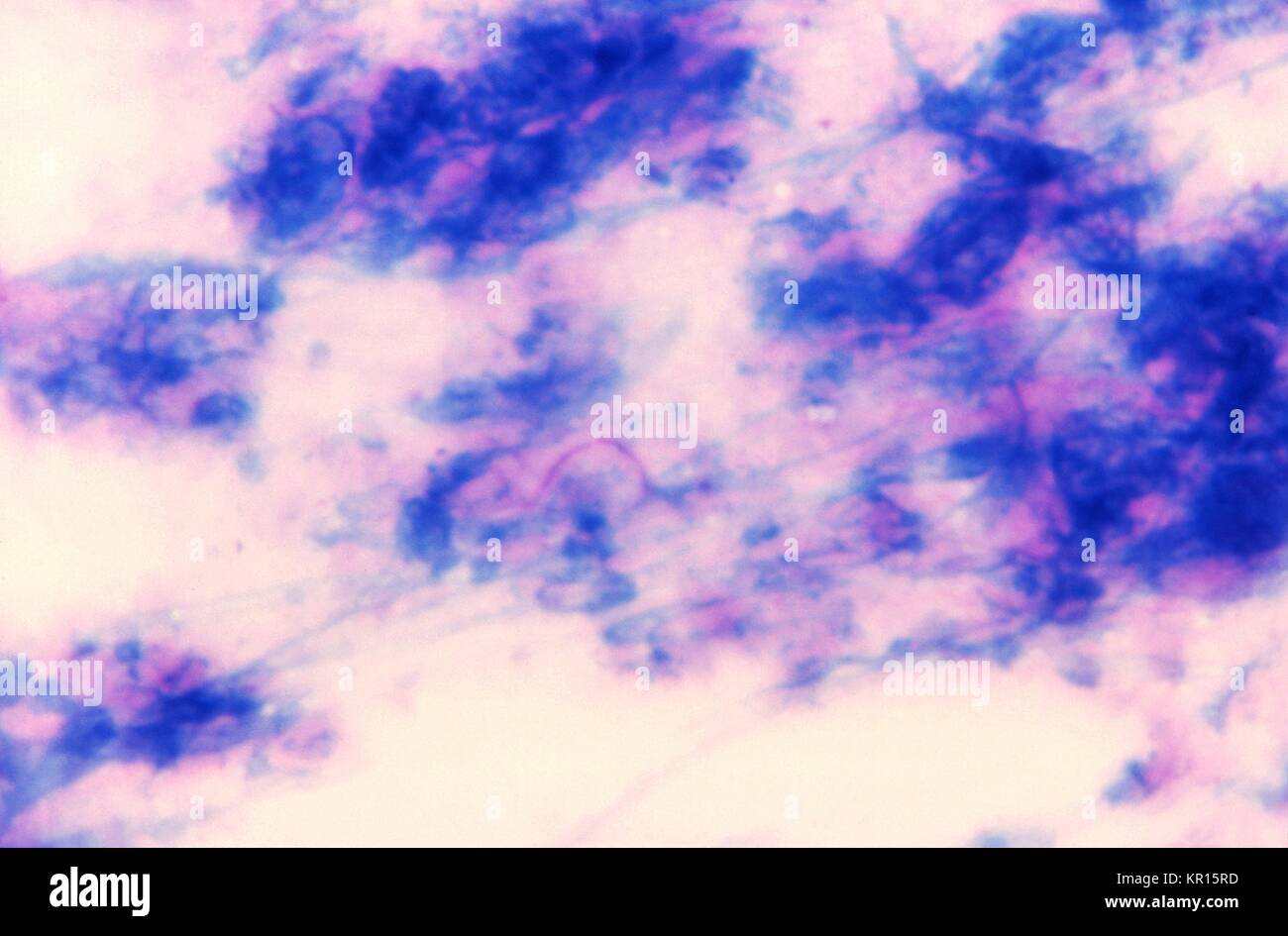 Eine photomicrograph eines touch Vorbereitung von pus enthüllt Nocardia sp, 1969. Mit Säure-Färbung von Technik. Lungenerkrankung, Symptome sind Fieber, Husten und Schmerzen in der Brust, für das zentrale Nervensystem Krankheitssymptome sind in der Regel Kopfschmerz, Lethargie, Verwirrtheit, Krampfanfälle, und plötzlichen Angriff des neurologischen Defizits. Bild mit freundlicher Genehmigung von CDC/Dr. Leanor Haley. Stockfoto