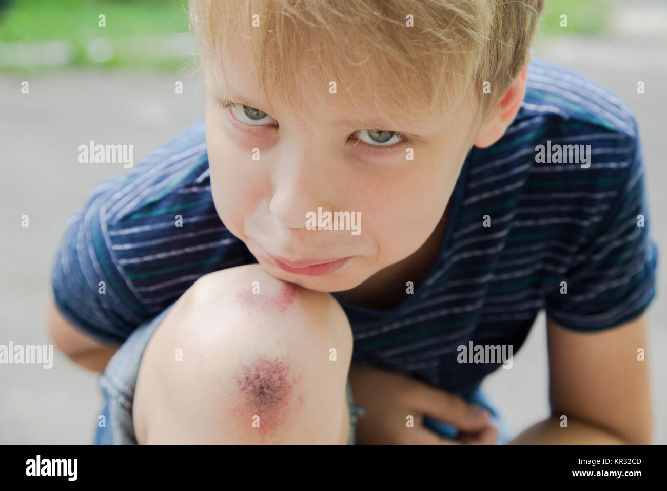 Nahaufnahme des verletzten Jungen kid Knie, nachdem er sich auf Pflaster fiel. Boy's Gesicht und Verwundeten abgekratzt Bein auf Sommer Tag im Freien. Horizontale Color Foto. Stockfoto