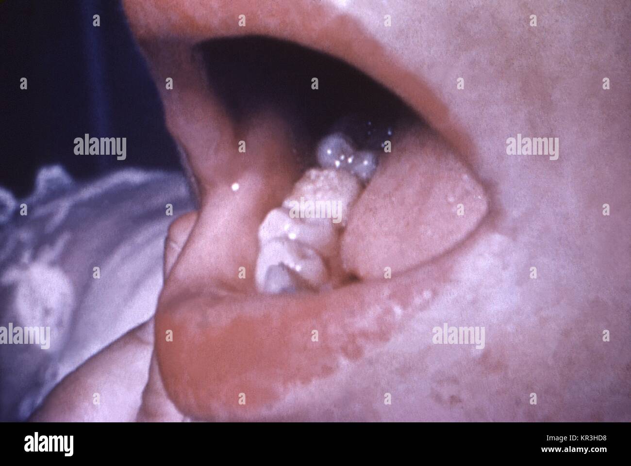 Dieses Bild zeigt das Gebiss eines angeborenen Syphilis Patienten, die  wegen dieser Krankheit, ging weiter zu entwickeln, was als Mulberry molaren  bekannt sind. ?, 1967. Mond?, Oder mulberry Molaren, ist ein Zustand,