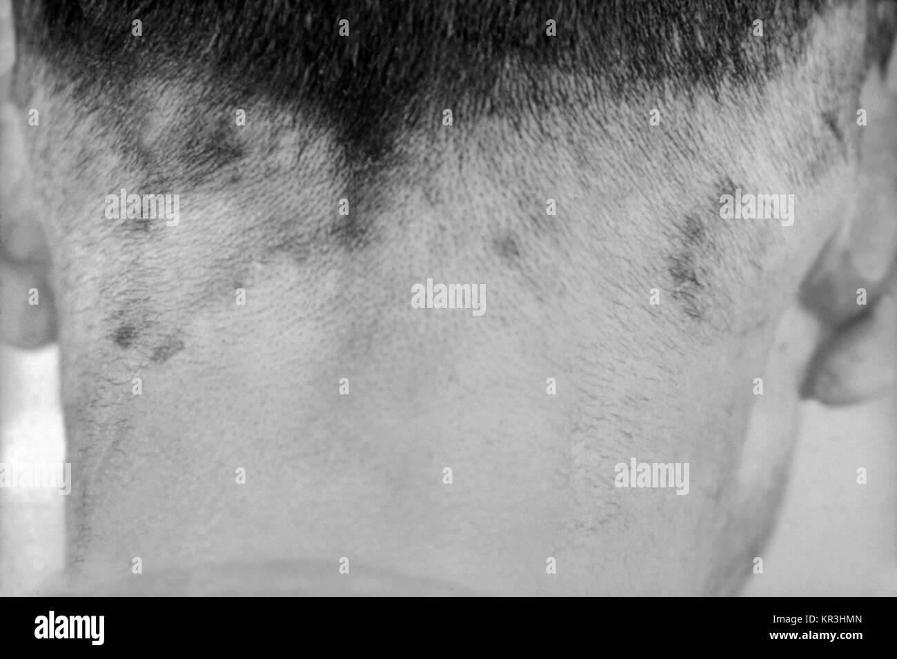Ein Foto von einem Patienten mit tertiäre Syphilis, die in gummas hier auf der Kopfhaut zu sehen. Tertiäre Syphilis tritt auf, viele Jahre nach der unbehandelten primären Syphilis, 1971. Gummas oder innere Gewebe Granulation, Form und zu schweren Schäden an der Haut, Knochen und Leber. Mit freundlicher CDC/Susan Lindsley. Stockfoto