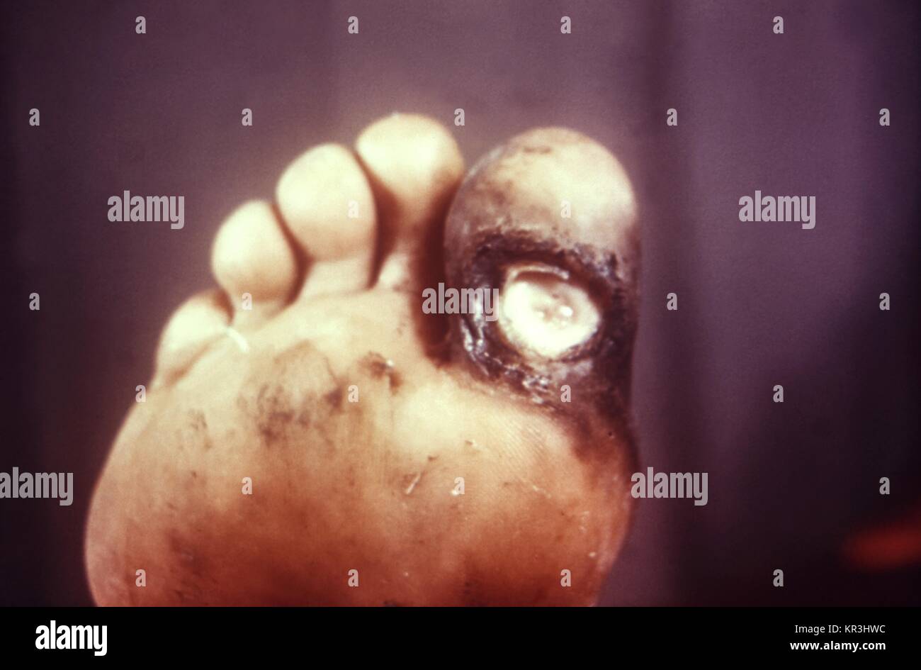 Bildunterschrift: <b> Zusätzliche Informationen:</b><br />Dieser Patient ein perforieren Geschwür von grosse Zehe aus Tabes dorsalis entwickelt hatte, eine Form der neurosyphilis, 1971. Diese Bedingung ergibt sich aus der Zerstörung der dorsalen Spalten im Rückenmark, normalerweise verantwortlich für die Einerstelle Sinn. Mit freundlicher CDC. Stockfoto