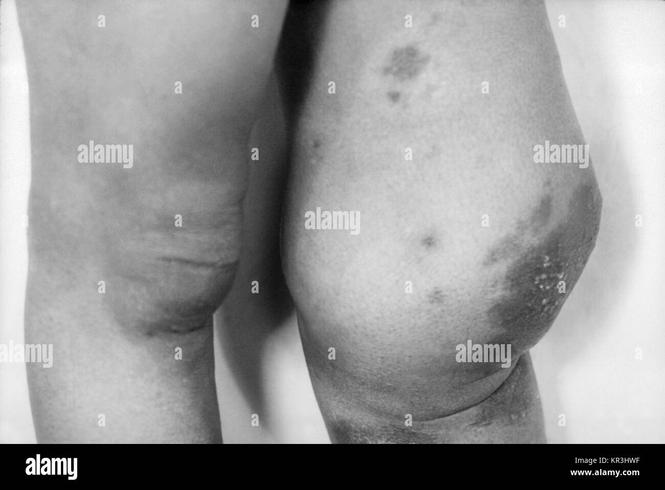Foto von neuropathischen Patientenzahl (Charcot gemeinsame) von tertiäre Syphilis führt. Dieser Patient nachhaltig fortschreitende Zerstörung, Verfall, und Desorganisation des Kniegelenks von einem Verlust der Empfindung, die durch die langjährigen Tabes dorsalis, 1971 verursacht. Diese Bedingung wurde bei tertiäre Syphilis gebracht. Mit freundlicher CDC/Susan Lindsley. Stockfoto