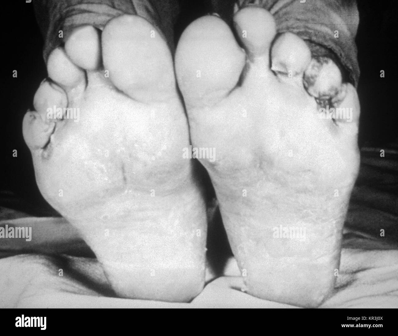 Ein Foto von syphilitische Papeln in der intertriginous Bereiche der Zehen. Ein Patient mit feuchten Papeln in der intertriginous Bereiche zwischen den Zehen, 1971. Diese klinische Manifestation tritt während der zweiten Phase der Syphilis, und wird durch das Bakterium Treponema pallidum verursacht. Mit freundlicher CDC/Susan Lindsley. Stockfoto
