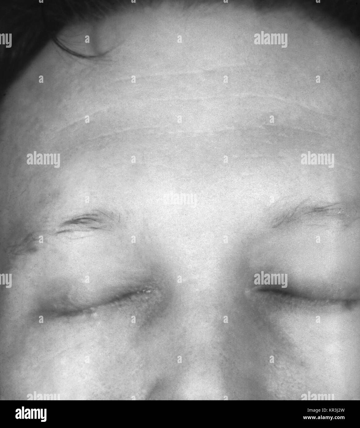 Ein Foto von augenbraue Alopezie oder Haarausfall, durch sekundäre Syphilis verursacht. Dieser Patient entwickelte eine Augenbraue Alopezie während der zweiten Phase der Syphilis, 1971. Andere Symptome, die während dieser Phase auftreten können sind leichtes Fieber, Müdigkeit, Kopfschmerzen, Halsschmerzen und geschwollene Lymphdrüsen. Mit freundlicher CDC/Susan Lindsley. Stockfoto
