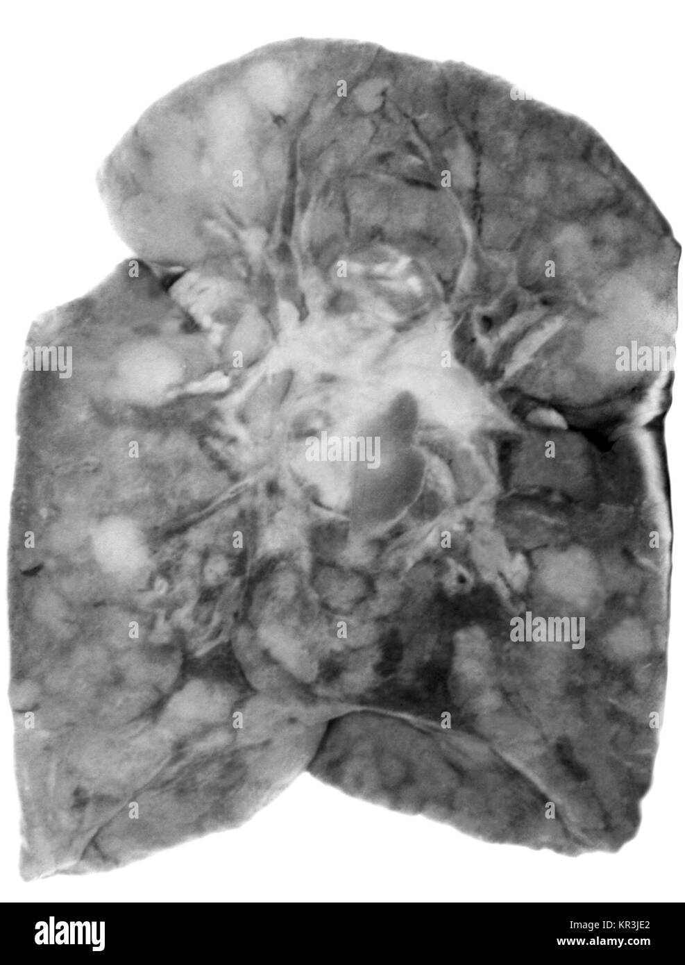 Dies ist ein pathologischer Zustand der Lunge wie Lungenentzündung Alba, und wird durch die angeborene Syphilis verursacht. Die Lungen sind vergrößert, schwer, gleichmäßig fest, und gelb-weißer Farbe, 1971. 70% aller schwangeren Frauen mit unbehandelten primären Syphilis kann die Infektion auf den Feten übertragen. Mit freundlicher CDC/Susan Lindsley. Stockfoto
