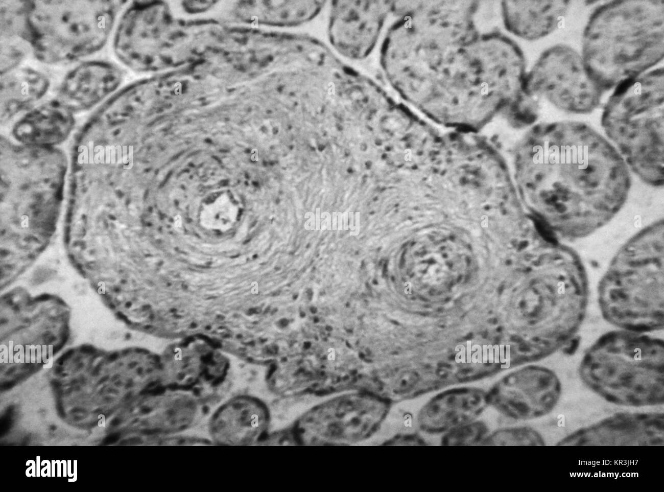 Eine aufschlussreiche photomicrograph cytoarchitectural Veränderungen der angeborenen Syphilis der Plazenta zu sehen. Die Chorionzotten vergrößert werden, und Dicht laminiert Bindegewebe enthalten, und die Kapillaren in den Darmzotten verteilt werden durch dieses Bindegewebe Verbreitung komprimiert, HandE Fleck, Vergrößerung 450X, 1971. Mit freundlicher CDC/Susan Lindsley. Stockfoto