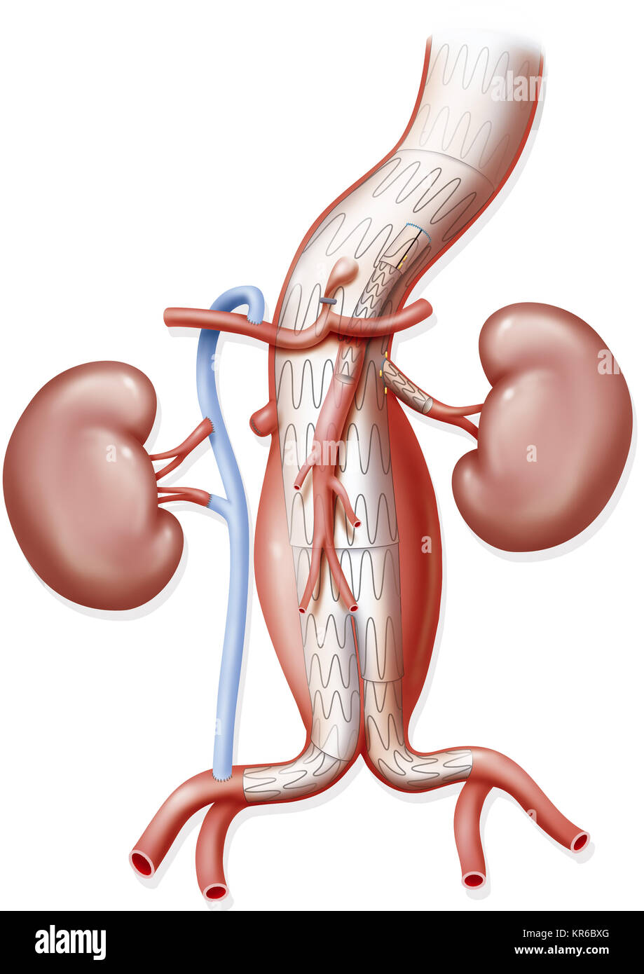 ANEURYSMA BEHANDLUNG Stockfoto