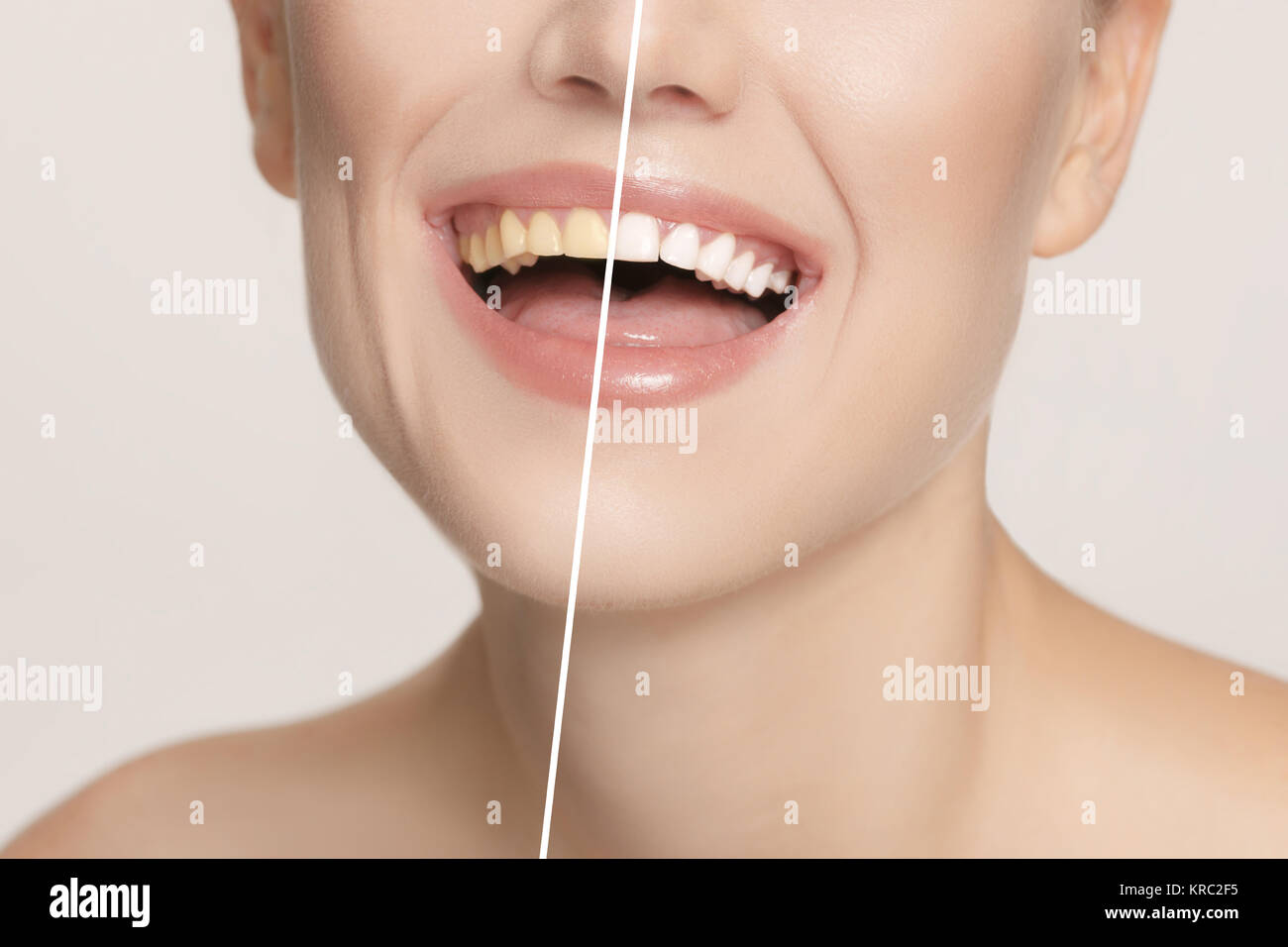 Die weibliche Zähne vor und nach der Aufhellung. Stockfoto