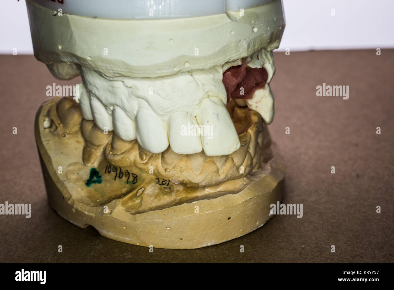 Zähne mit Implantaten Stockfoto