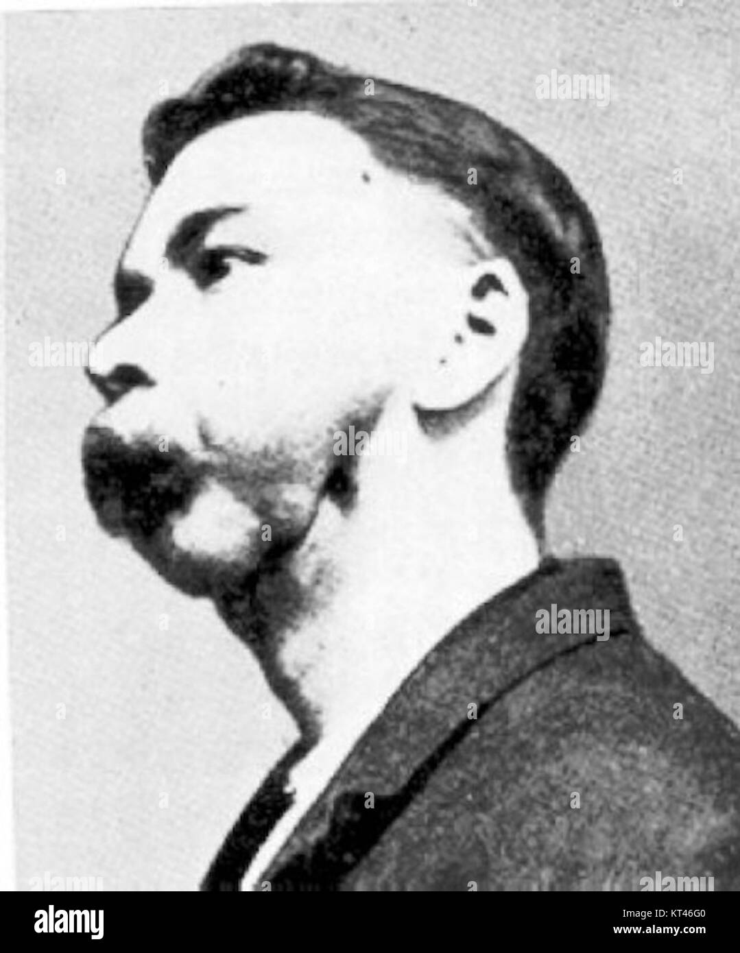 Phossy Kiefer war eine ernste Erkrankung, die die Arbeiter in der Matchfabrik im 19. Und frühen 20. Jahrhundert betraf, verursacht durch die Exposition mit Phosphor. Es führte zu schweren Kieferdeformitäten und war ein großes Geburtsproblem in dieser Zeit. Stockfoto