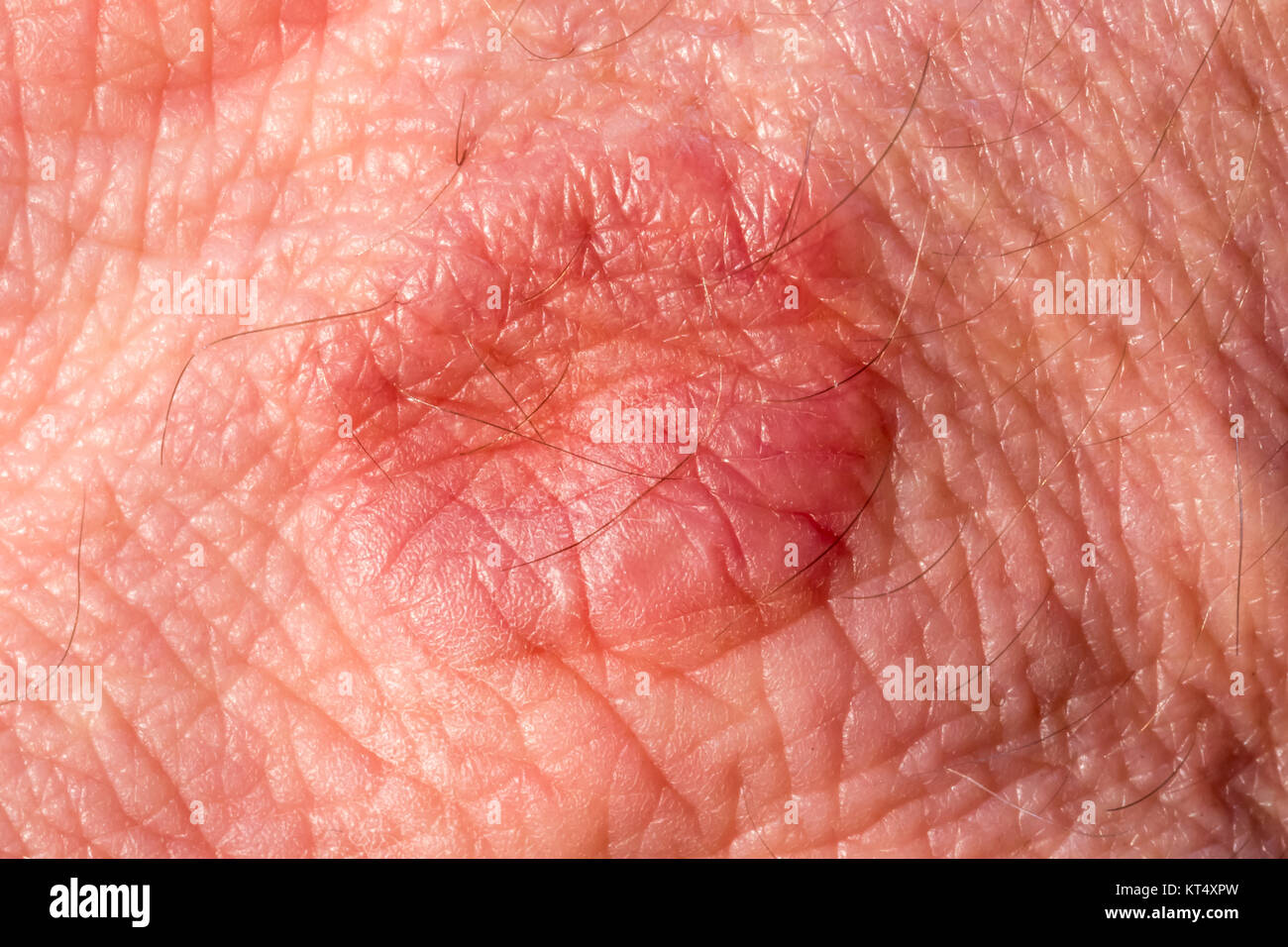 Haut mit Hautausschlag/Ekzem Stockfoto