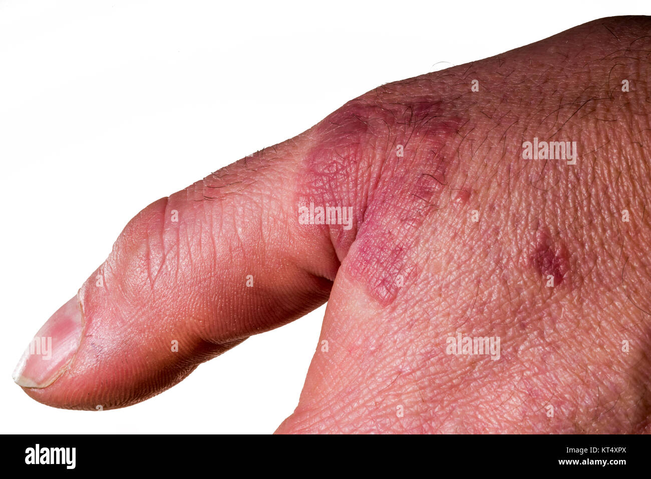 Hand mit Hautausschlag/Ekzem Stockfoto