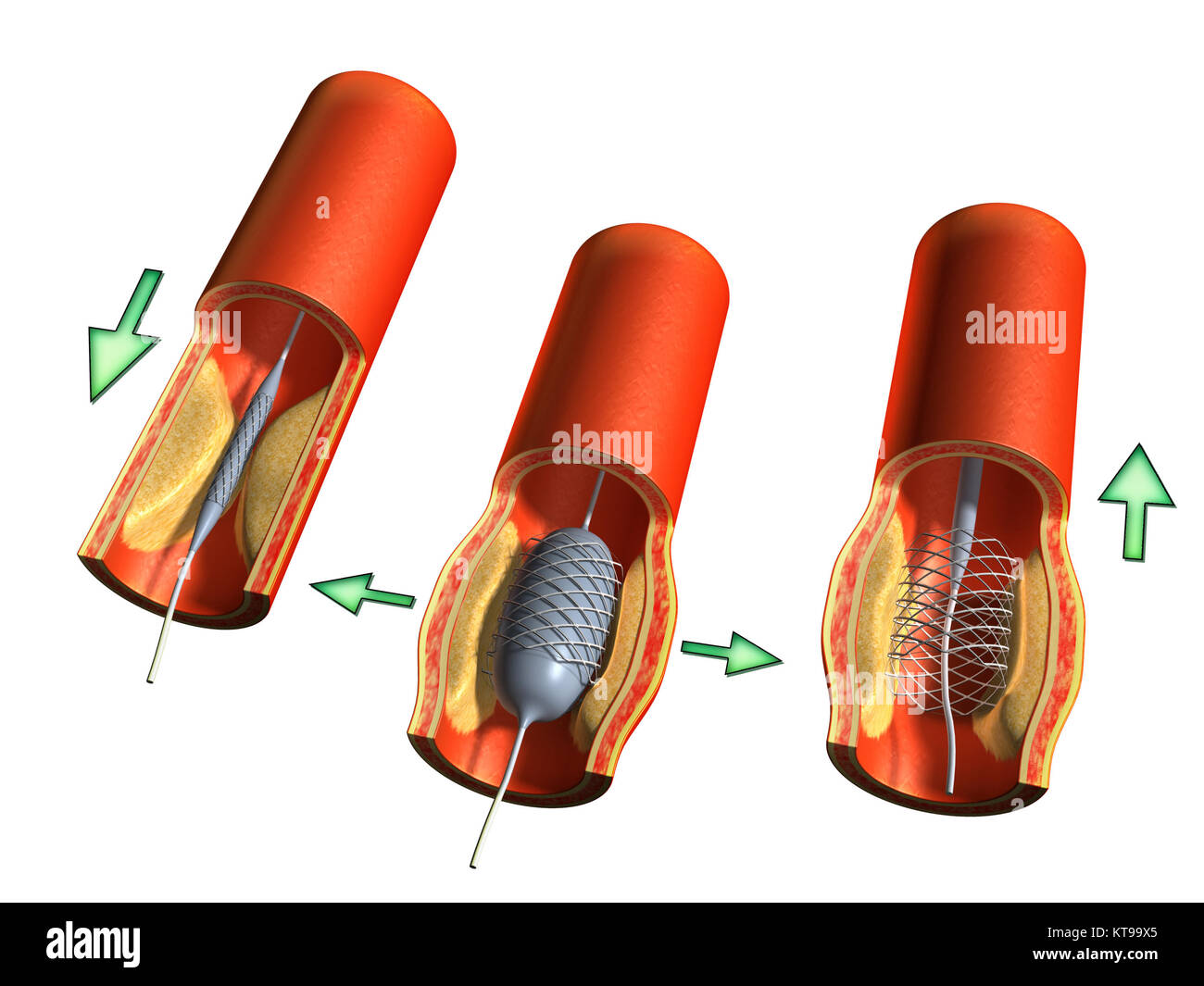 Angioplastic Betrieb für die Therapie von einer arteriellen Plaque. Digitale Illustration, clipping path enthalten. Stockfoto