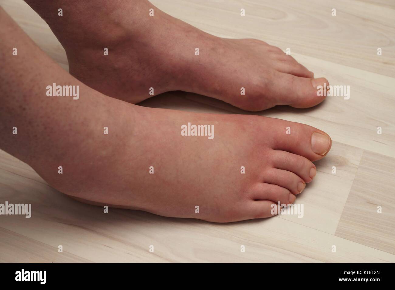 Schmerzhafte allergische Reaktion auf den Fuß aufgrund von Wespenstich Stockfoto