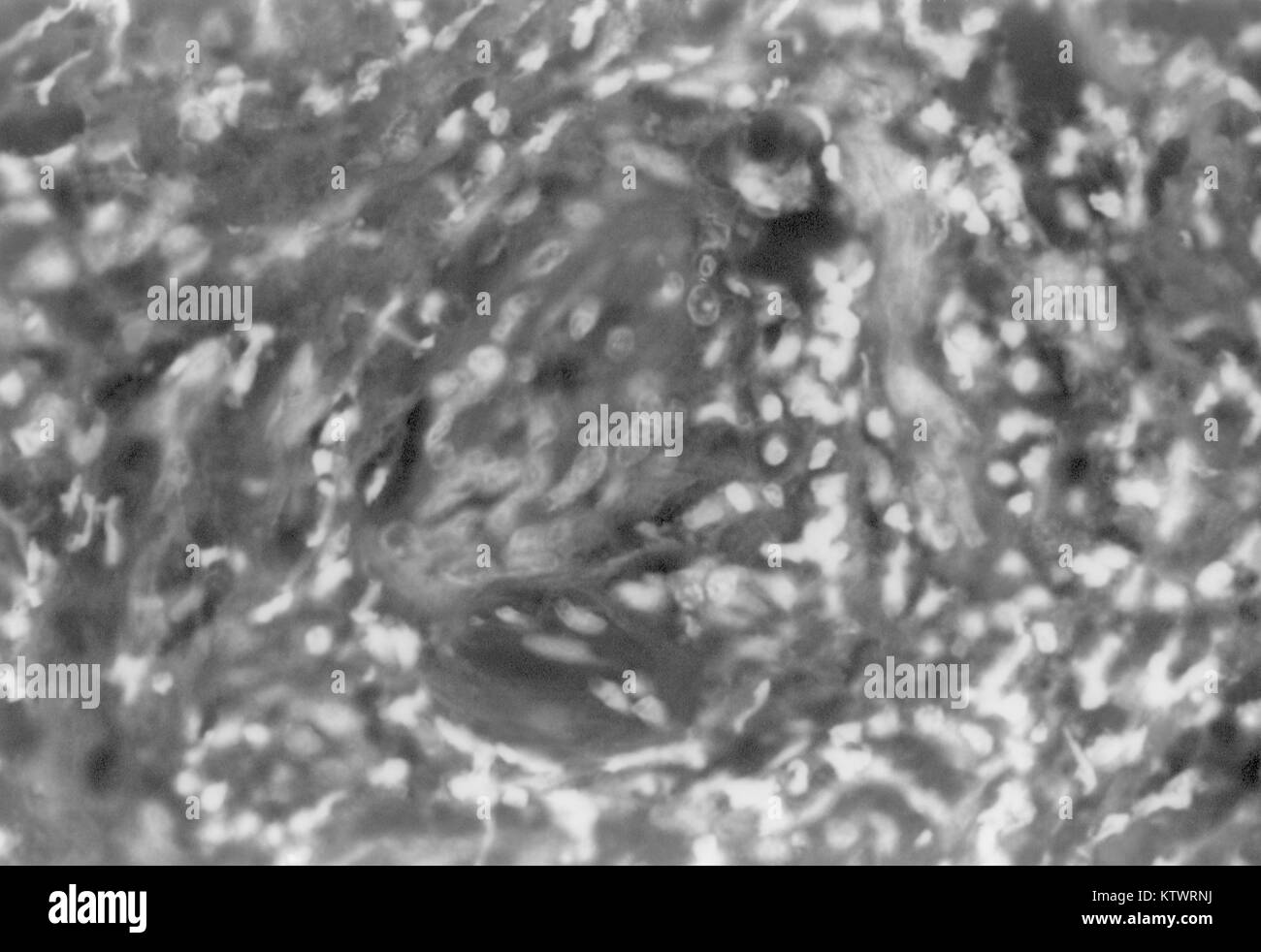 Eine photomicrograph eines Condyloma latum Läsion, bezeichnend für sekundäre Syphilis. Pathognomonisch Ergebnisse hier gesehen markiert die endotheliale Proliferation, und perivaskuläre entzündliche cuffing bezeichnenderweise in der Dermis gesehen, HandE Färbung Technik, Vergrößerung 400X, 1971. Mit freundlicher CDC/Susan Lindsley. Stockfoto