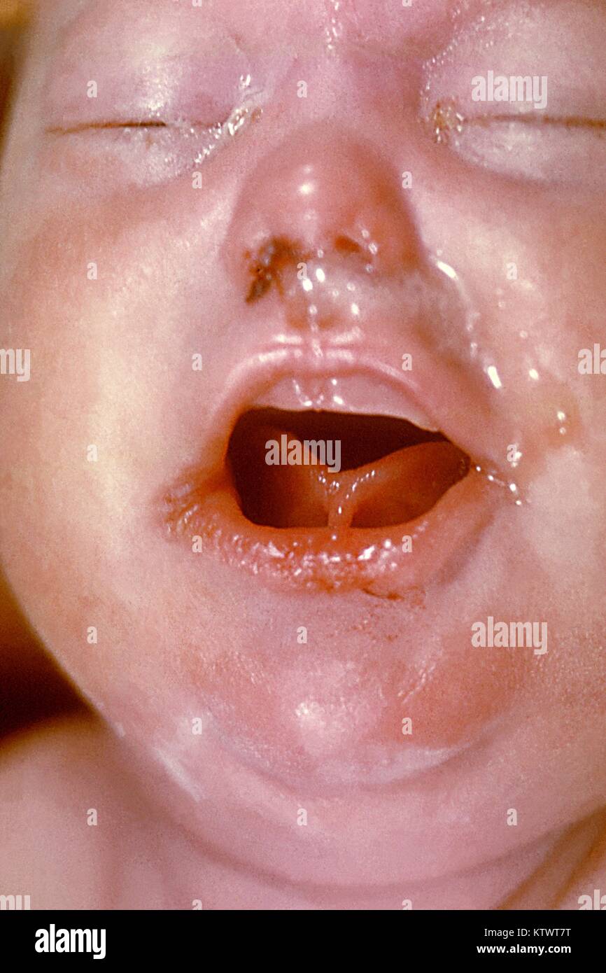 Das Gesicht Eines Neugeborenen Kindes Darstellung Von Pathologischen Morphologie Indikative Die Angeborene Syphilis Eine Schwangere Frau Mit Syphilis Kann Pass T Pallidum Auf Ihr Ungeborenes Kind Die Mit Schweren Psychischen Und Physischen